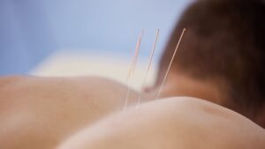 Hero-sports-acupuncture